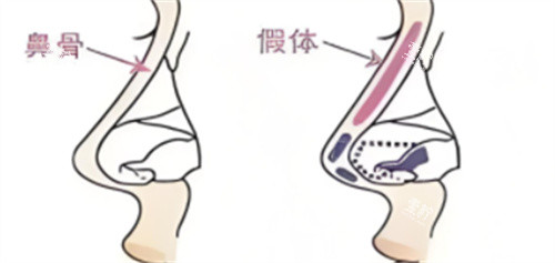 鼻综合假体植入.jpg 鼻综合假体植入.jpg