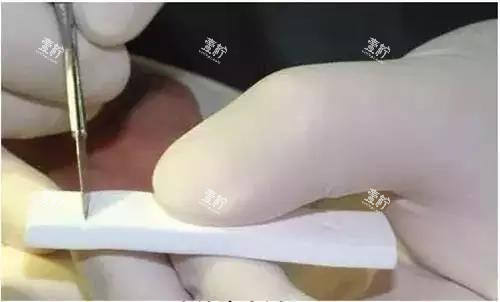 隆鼻手术雕刻中的膨体.jpg 隆鼻手术雕刻中的膨体.jpg