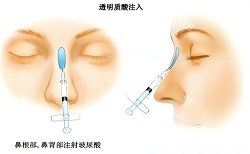隆鼻玻尿酸注射图.jpg 隆鼻玻尿酸注射图.jpg
