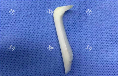 取出的隆鼻假体.jpg 取出的隆鼻假体.jpg