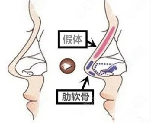 隆鼻示意图.JPG 隆鼻示意图.JPG