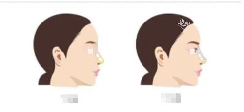 隆鼻前后对比示意图.png 隆鼻前后对比示意图.png