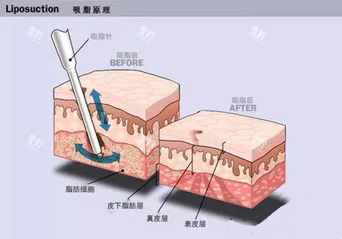 水动力吸脂手术原理动画图.jpg