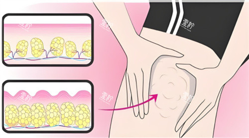 吸脂大腿部位.jpg