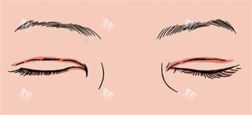 双眼皮疤痕修复.jpg