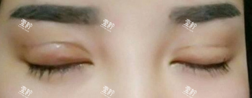 双眼皮失败照片.jpg