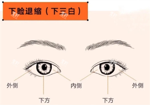 眼修复下睑退缩.jpg 眼修复下睑退缩.jpg