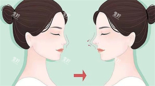 鼻修复对比.jpg 鼻修复对比.jpg
