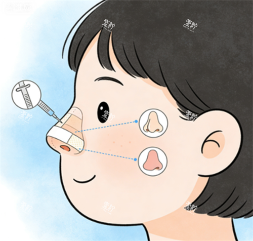 鼻修复的手术部位.png 鼻修复的手术部位.png