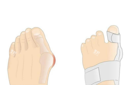 大脚骨矫正卡通图.jpg
