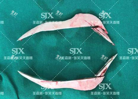 北京圣嘉新医疗美容医院张笑天下颌角手术截骨.jpg