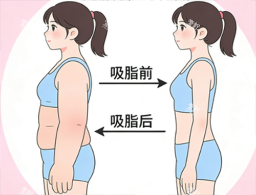 手臂吸脂成效.png 手臂吸脂成效.png