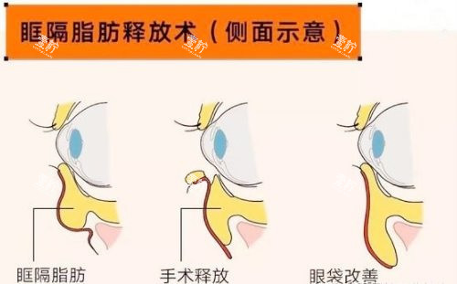 眶隔脂肪祛眼袋.jpg 眶隔脂肪祛眼袋.jpg