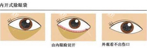 内切法祛眼袋手术过程.jpg 内切法祛眼袋手术过程.jpg