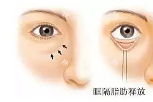 内切法眶隔脂肪释放.jpg 内切法眶隔脂肪释放.jpg