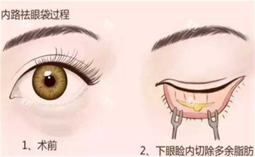 内切法祛眼袋手术.jpg 内切法祛眼袋手术.jpg