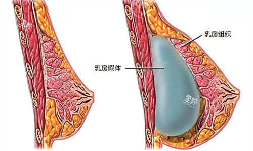 假体隆胸术原理图.jpg