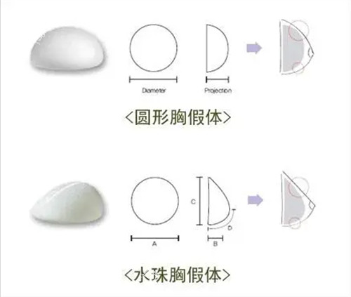 丰胸手术曼托圆形及水滴形假体植入示意图.jpg