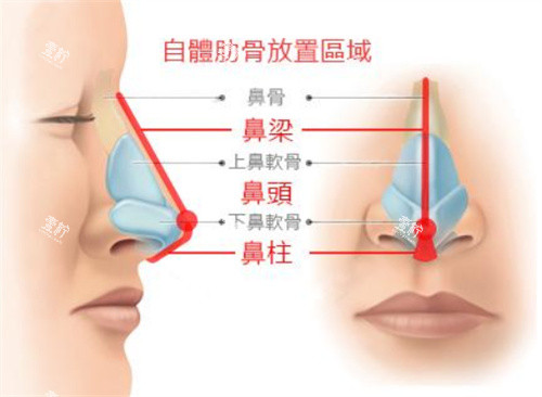 鼻部整形示意图.jpg