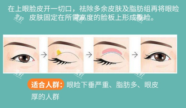 全切双眼皮解析.jpg