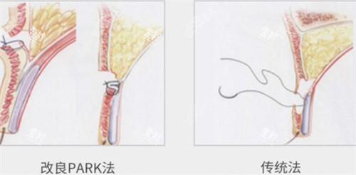 park双眼皮和传统对比.jpg