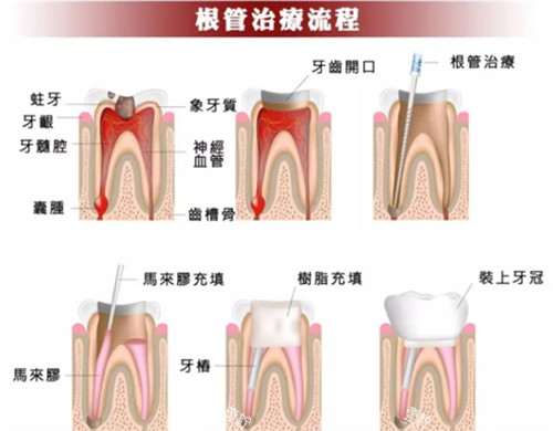 根管治疗流程.jpg 根管治疗流程.jpg
