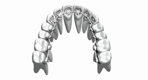 牙齿矫正舌侧矫正牙套概念透视图.jpg