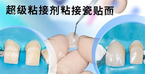 登士柏西诺德瓷贴面粘接操作.jpg 登士柏西诺德瓷贴面粘接操作.jpg