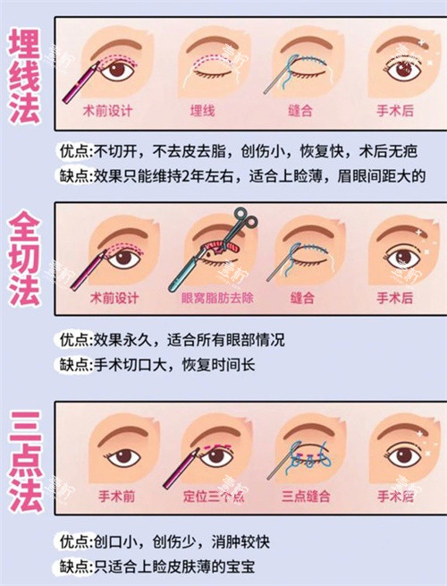 双眼皮三种手术方式动画.jpg