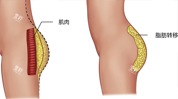 自体脂肪丰臀脂肪示意图.png