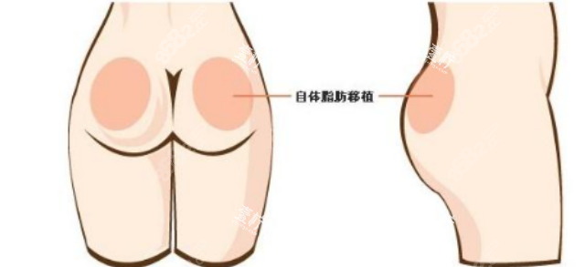 臀部塑形手术.png