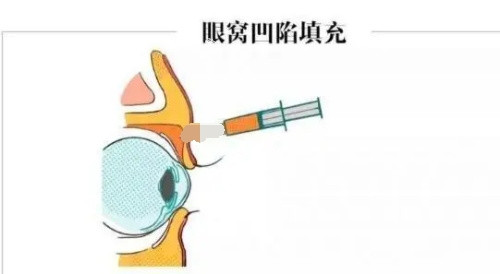 眼窝凹陷填充.jpg