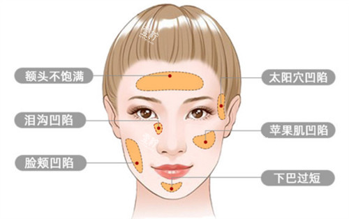 面部脂肪填充适应症.jpg