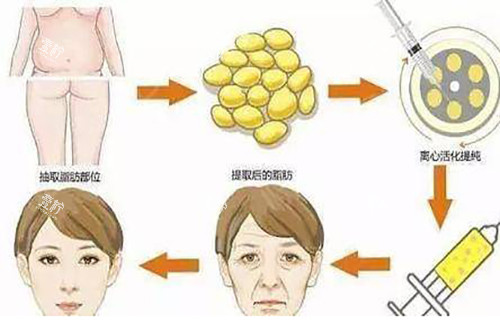 面部脂肪填充过程示意图.jpg