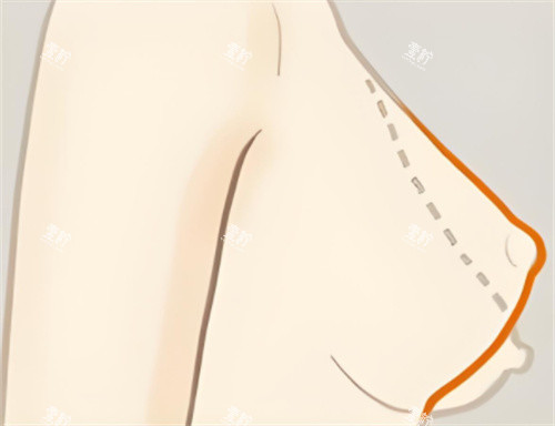乳房下垂矫正轮廓对比.jpg 乳房下垂矫正轮廓对比.jpg