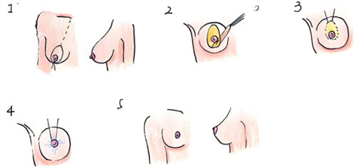 乳房下垂矫正术过程.jpg 乳房下垂矫正术过程.jpg
