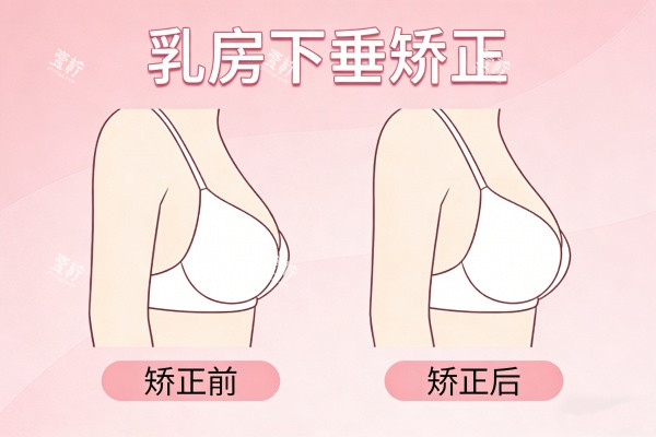 乳房下垂矫正前后对比图.jpg 乳房下垂矫正前后对比图.jpg