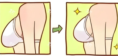 乳房下垂内衣穿着对比.jpg 乳房下垂内衣穿着对比.jpg
