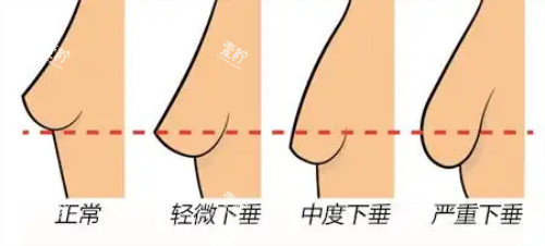 胸部下垂程度图片.jpg 胸部下垂程度图片.jpg