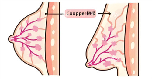 乳房下垂韧带组织对比.jpg 乳房下垂韧带组织对比.jpg