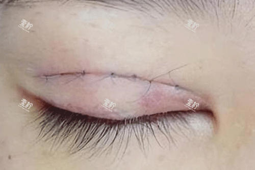 双眼皮疤痕明显照片.png