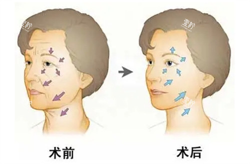 面部年轻化管理前后对比.jpg 面部年轻化管理前后对比.jpg