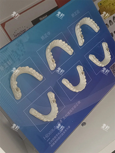 复查那天，我朋友在天津中瑛口腔医院隐形矫正的真实经历，效果能看出来吗