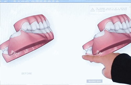 隐形牙齿矫正3D模型展示.png 隐形牙齿矫正3D模型展示.png