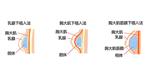 假体隆胸假体植入层次图.png