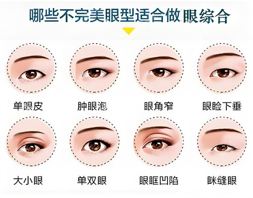 哪些眼型适合做眼综合示例动画图.jpg 哪些眼型适合做眼综合示例动画图.jpg