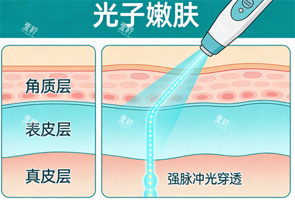 光子嫩肤操作卡通示意图.jpg 光子嫩肤操作卡通示意图.jpg