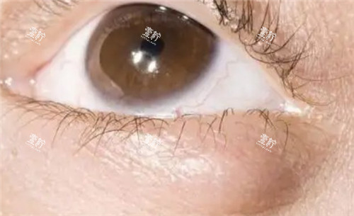 眼部霰粒肿照片.jpg
