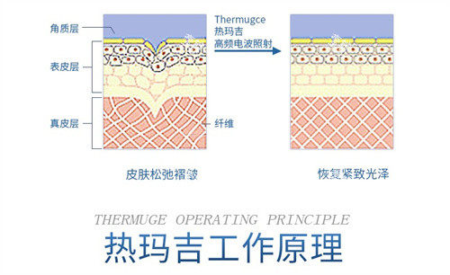 热玛吉工作示意图.jpg