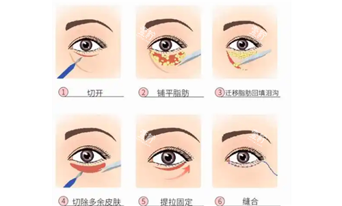 眼部脂肪重排.png